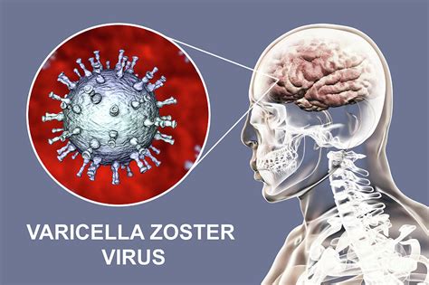 Encephalitis Caused By Varicella Zoster Virus 2 Photograph By Kateryna