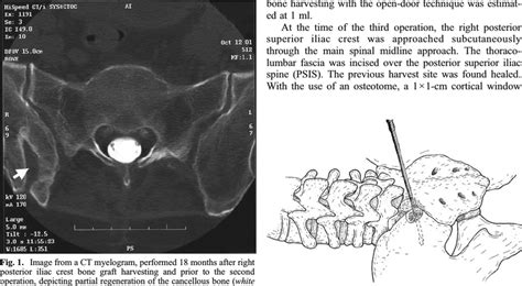 Image From A Ct Myelogram Demonstrating That The Iliac Cancellous Bone