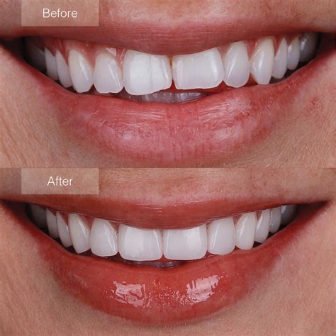 Teeth Before And After Veneers