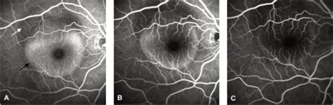 Fluorescein Angiogram Of Right Eye Performed At The Fir Open I