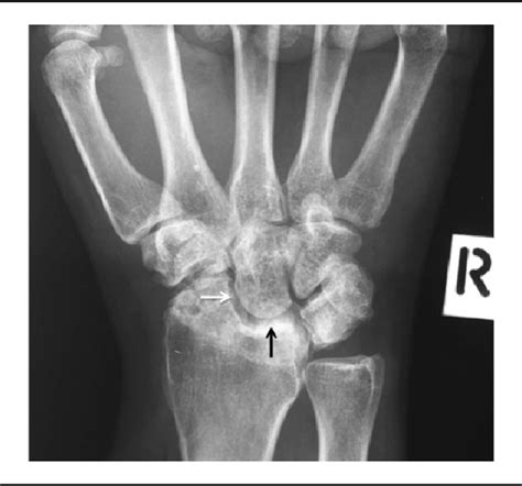 Figure From Radioscapholunate Fusion With Triquetrum And Distal Pole Of Scaphoid Excision