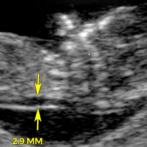 Here is a brief guide on nt scan which will give an overview about what it is, nt scan procedure, who should go for nuchal translucency screening, nt scan sonography, risks of nt screening and many more. Nuchal translucency (NT) scan - BabyCenter