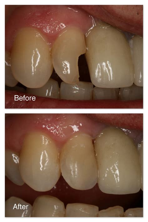 Restoration Of Fractured Teeth Gallery Dr Jack M Hosner Dds