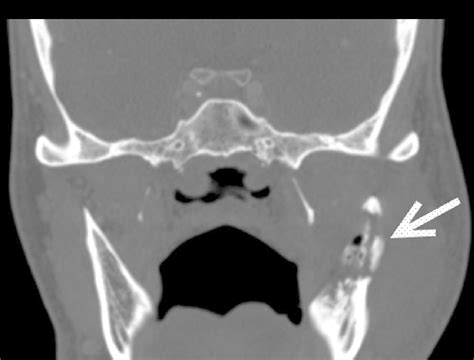 Ct Examination Of Head And Neck Lower Border Axial Scan Soft Tissue