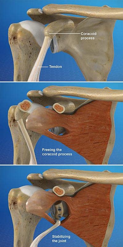 Latarjet Procedure For Shoulder Instability Central Coast Orthopedic