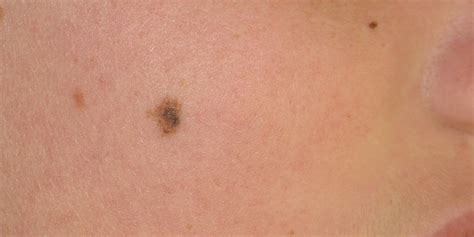 Atypical Melanocytic Lesions Skin Cancer And Reconstructive Surgery