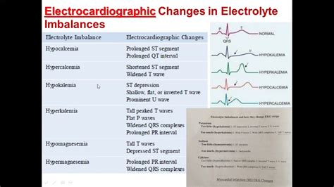 Electrolyte Abnormalities And Ecg Changes Google Search Nurse