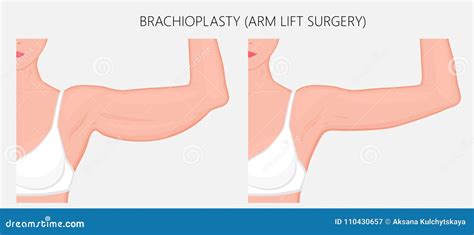 Brachioplasty Arm Lift Surgery Infographic Medical Poster Cartoon