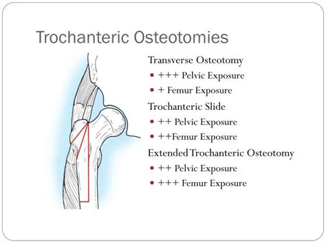 Ppt Exposure Options For Hip Revision Trochanteric Osteotomies