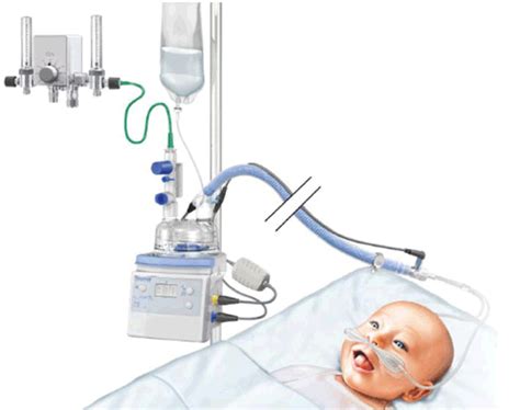Cuidados De Enfermería En Pacientes Con Oxígeno De Alto Flujo Y Ventilación No Invasiva