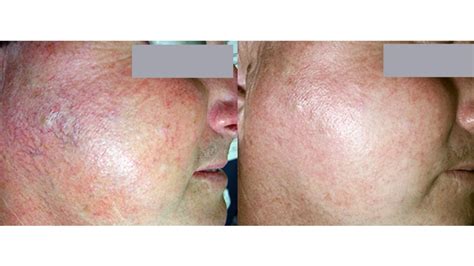 Rosacea Laser Treatments Woman And Girls