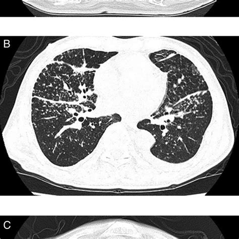 A High Resolution Computed Tomography Of The Lung Showed Small