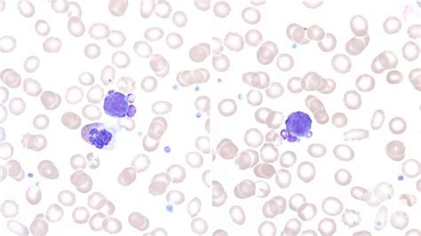 Peripheral Blood Smear 2015 Lymphoid Cells With Nuclear