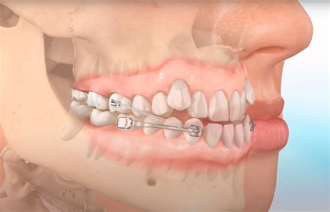 Invisalign And Carriere Motion Appliance Moira Wong Orthodontics