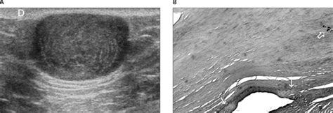 Epidermal Cysts In The Superficial Soft Tissue Huang 2011 Journal