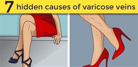 Hidden Causes Of Varicose Veins