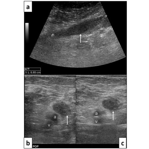 Case 3 67 Years Old Woman Ultrasound Guided Biopsy Of The Thigh Mass