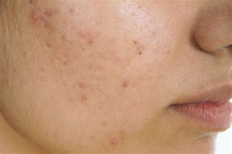 How To Cure Acne When You Have Dry Skin Practical Guide