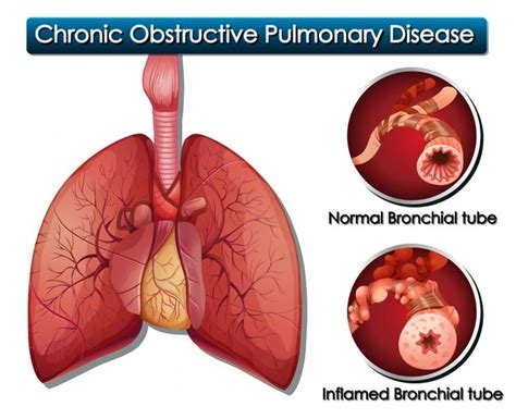 Diagrama Mostrando Doen A Pulmonar Obstrutiva Cr Nica Vetor Gr Tis The Best Porn Website