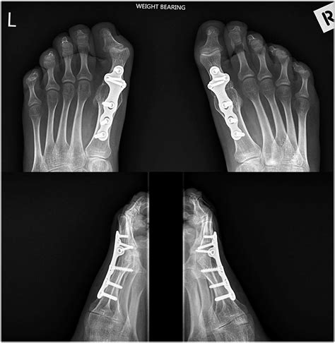 Arthrodesis Of The First Metatarsophalangeal Joint For Severe Hallux