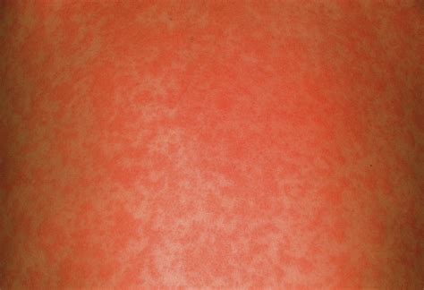 Measles Rash Photograph By Cnriscience Photo Library Pixels