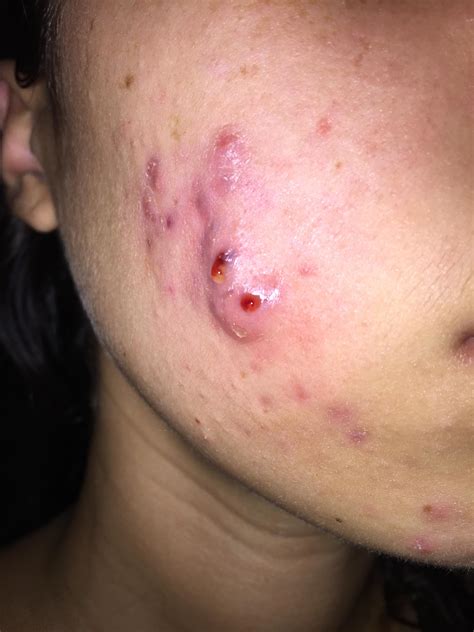 Just A Bad Cystic Acne Infection Or Something Worse Please Help