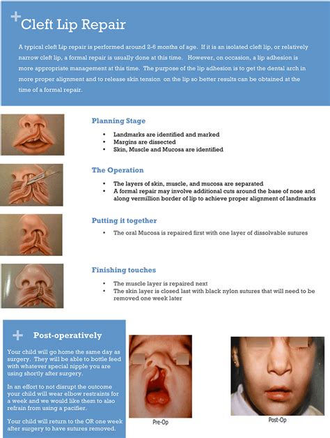 Cleft Lip And Palate Craniofacial Clinic Childrens Faces