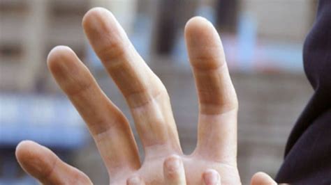 Finger Length Predicts Prostate Cancer Risk Study