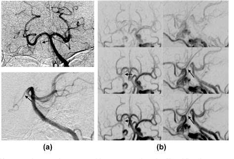 Figure 2 From Collateral Circulation Via The Circle Of Willis In