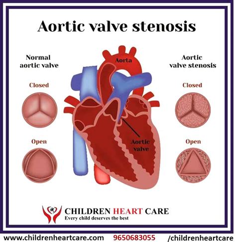 Aortic Stenosis Treatment In Delhi Dr Gaurav Agrawal