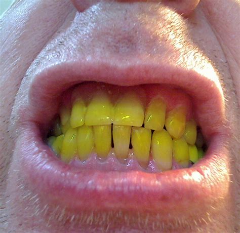 My Yellow Teeth Free Stock Photo - Public Domain Pictures