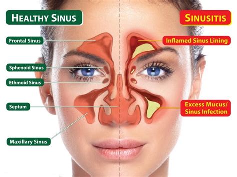Chronic Sinusitis Sinus Infection Treatment Dr Monica Tadros