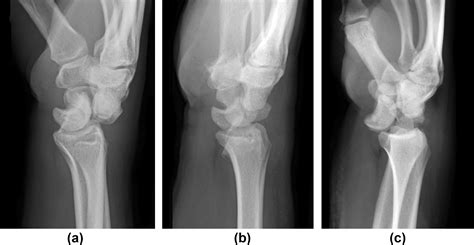 Perilunate Injuries Biomechanics Imaging And Classification Clinical Radiology