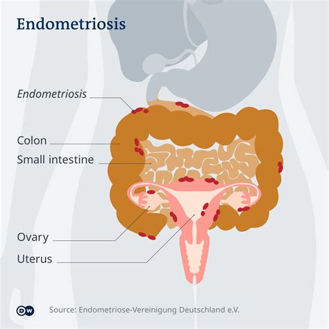 Endometriosis Myyarmunirah