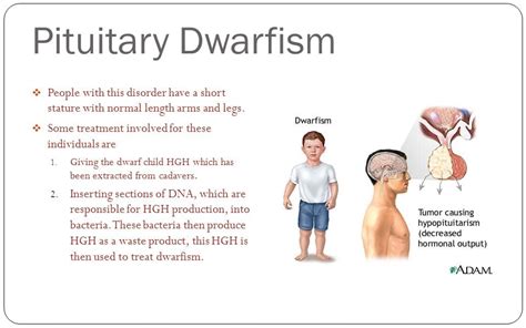 Pituitary Dwarfism Gh Deficiency Smarty Pance