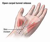 What Type Of Doctor Does Carpal Tunnel Surgery