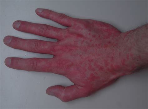 my atripla rash experience: day 11