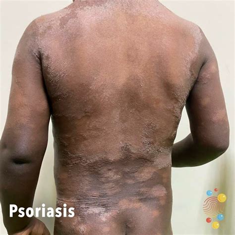 Psoriasis Skin Deep
