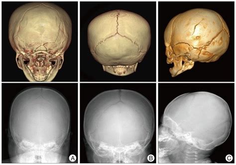Linear Skull Fracture In The Simple X Ray And 3