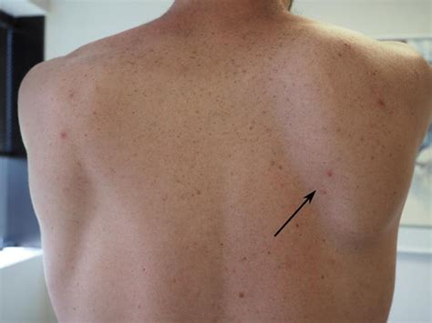 Scapular Shoulder Blade Problems And Disorders Orthoinfo Aaos