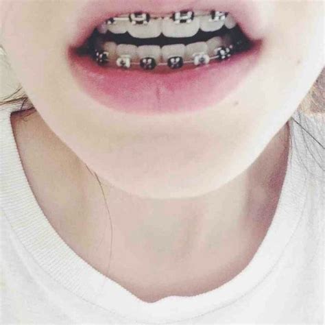 Pin By Audrey On Aesthetic Horrorclothescuteothers Braces Colors
