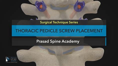 Surgical Techniques Thoracic Pedicle Screw Placement Youtube