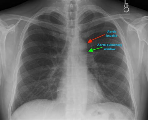Aortic Arch Chest X Ray Interpretation X Ray Radiology