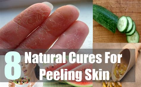8 Natural Cures For Peeling Skin Natural Home Remedies And Supplements