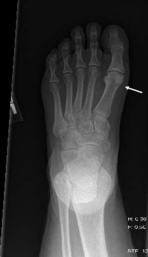 Non Fifth Metatarsal Fracture Wikem