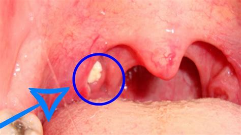 Tonsil Stones Largest Tonsil Stone Removal 2020 Youtube