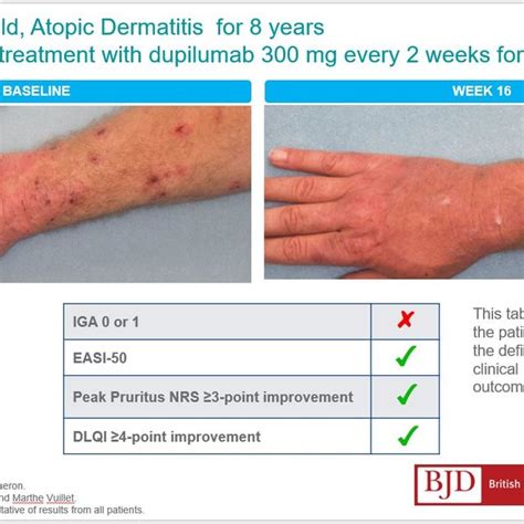 Example Of Case Before And After Treatment With Dupilumab 300mg Every