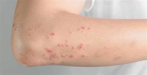 Dermatite O Que Causas Sintomas E Como Prevenir Panorama The Best