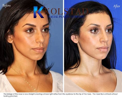 Hispanic Rhinoplasty Before And After Gallery 2 Dr Kolstad San Diego