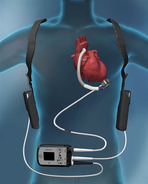 Ventricular Assist Device Vad Lvad New Jersey Valley Health System